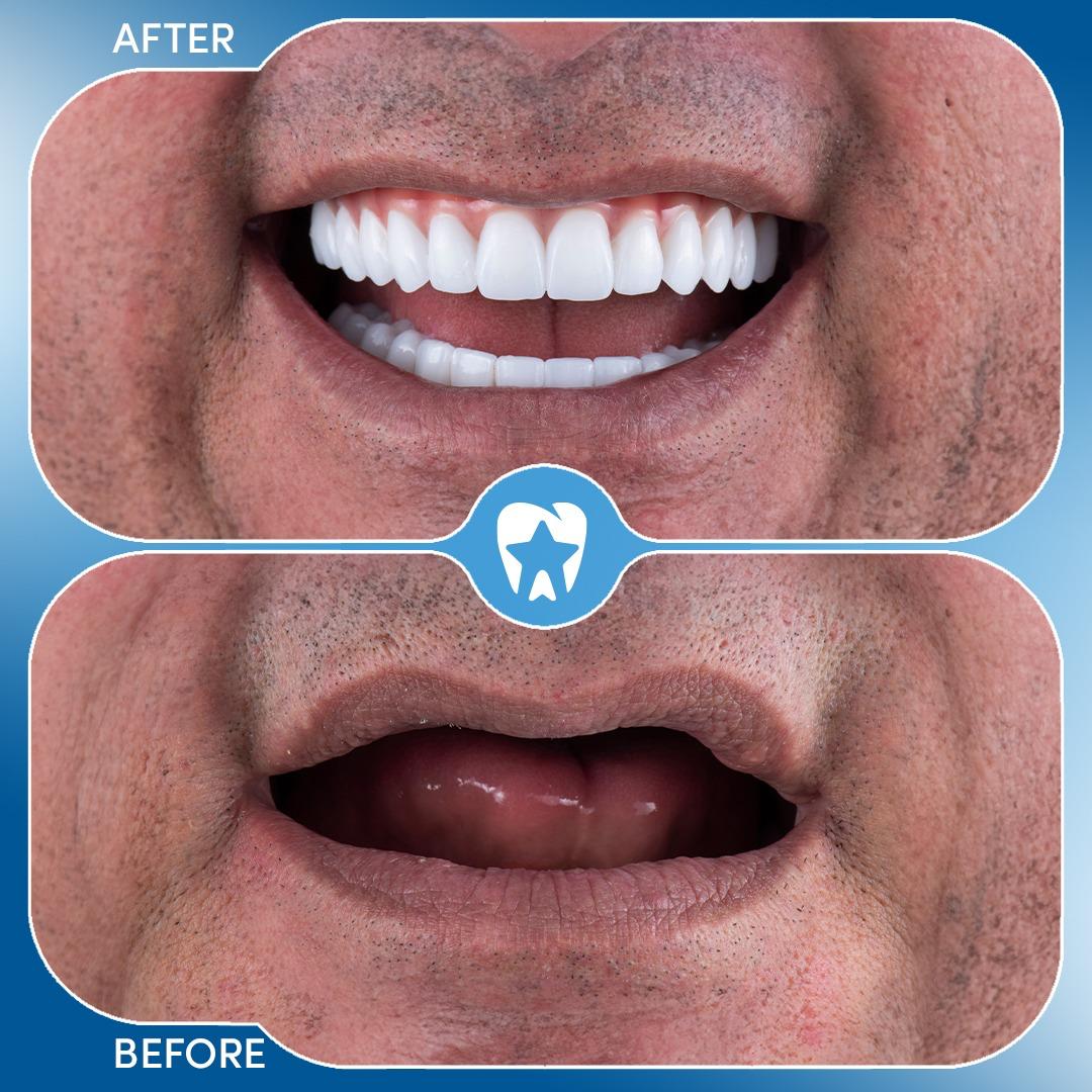 All on 4 (4 Implants + 12 Crowns) before and after